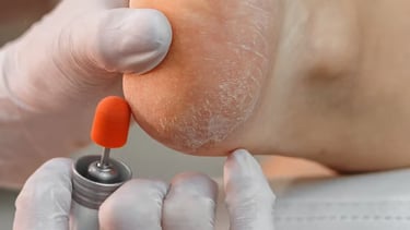 Fissuras e Rachaduras nos Pés | Talitha Miquelanti - Podóloga em Uberlândia | Podologia em Uberlândi