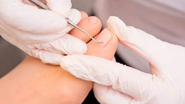 Unha Encravada | Talitha Miquelanti - Podóloga em Uberlândia | Podologia em Uberlândia