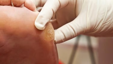 Calos nos Pés | Talitha Miquelanti - Podóloga em Uberlândia | Podologia em Uberlândia