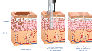 pico laser pigmentation diagram