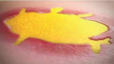 Omeza™ covering a chronic wound