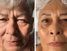 Awoman with a before and after photo after using a Riman skin care product