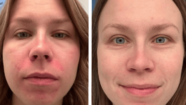 Awoman with a before and after photo after using a Riman skin care product