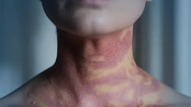 Close-up of a person's neck with a visible red and yellow rash, representing auto-immune disease
