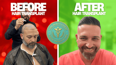 photo of before and after hair transplant result
