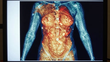 Close-up of a thermography scan result showing a human posterior torso in a clinical infrared color map — warm zones highlighted in amber and red against cooler blue-green areas, precise anatomical framing. Flat studio strobe lighting on the display surface, no ambient warmth, clinical documentation style.