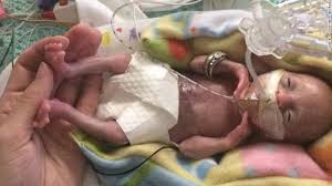 neonato com pouca chance de vida