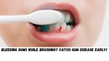 Bleeding Gums