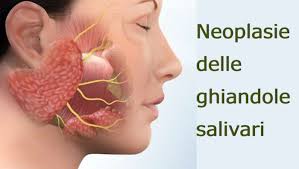 Illustrazione di un tumore della ghiandola salivare operabile dal Dott. Porro