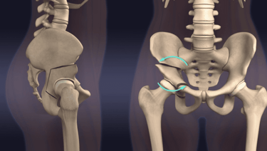 Osteotomia de Ganz, Berna, ou PAO.