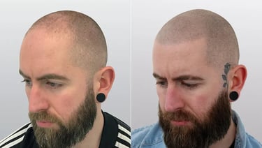 Best Scalp Micropigmentation Toronto_ATRUBARBER