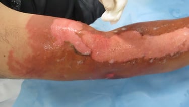 burn wound