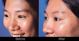 Botox Treatment Before and After