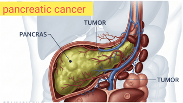 Pancreatic cancer,, naturopathy treatment, yoga therapy, causes of cancer, symptoms of cancer.