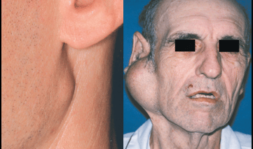 adenoma pleomórfico patologias de glândulas salivares resumo patologia bucal
