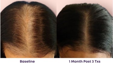1 month after 3 treatments, the part is narrower and the hair is thicker and fuller
