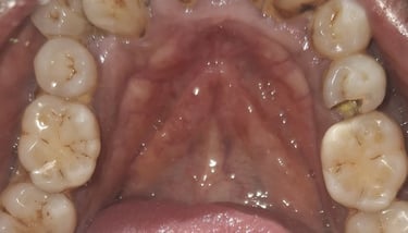deep decayed tooth with pain and food lodgement at shree dental care near jivraj