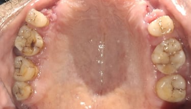 severely worn teeth with multiple cracks and hyper sensitivity dentist at shree dental care