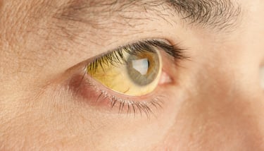 Jaundice Liver Cirrhosis