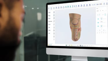 Prosthetist digitally designing a custom below-knee prosthetic socket using advanced CAD software