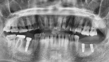 Poza caz pacient implanto 2