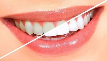 تبييض الأسنان في الكويت