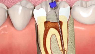 علاج عصب الأسنان