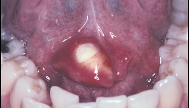 sialolitíase resumo patologia bucal concurso odontologia ducto de warthon