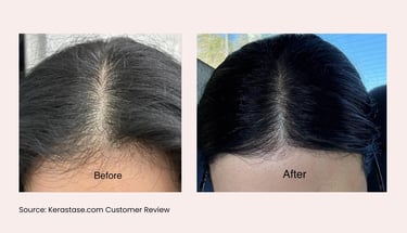 Visible reduction in scalp visibility and thicker hair part after consistent application of Aminexil