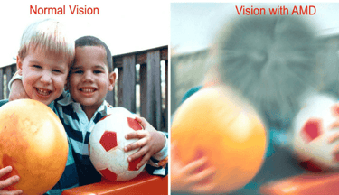 Vision with AMD Age Related Macular Degeneration ARMD