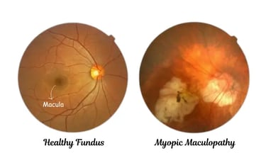 Fundus photograph showing myopic maculopathy with retinal changes near the macula