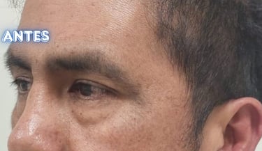 Dra. Lilyan Marissel - Cirugía Plástica y Estética - blefaroplastia-inferior-varon