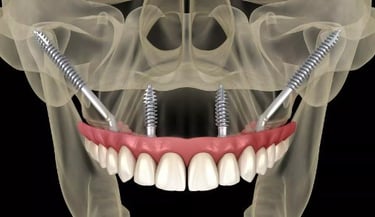 Zygomatic implants
