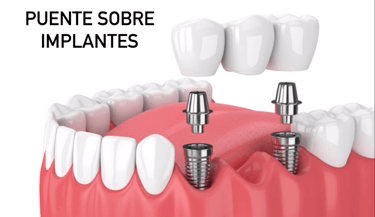 Puente sobre implantes