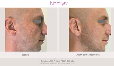 advanced skincare treatment for rough and uneven skin texture in Hamilton clinic