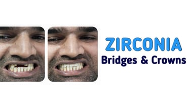 Zirconia Bridges and Crowns in Greater Noida