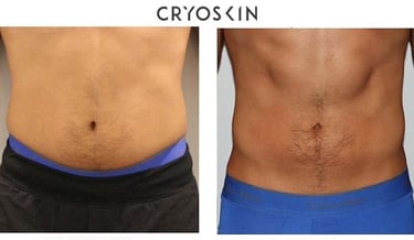 Cryolipolyse avant apres