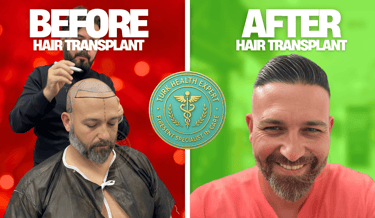 foto de antes y despues el injerto capilar con la FUE