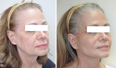 Yüz Germe (Facelift) Vaka