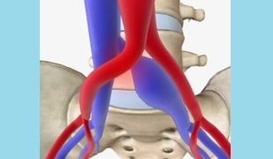 vascular ultrasound may thurner syndrome iliac vein common artery compression deep vein thrombosis swelling leg pain pelvic