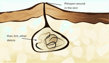 Diagram of a pilonidal cyst showing a skin pit and debris trapped in a subcutaneous cavity.