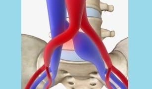 vascular ultrasound may thurner syndrome iliac vein common artery compression deep vein thrombosis swelling leg pain pelvic