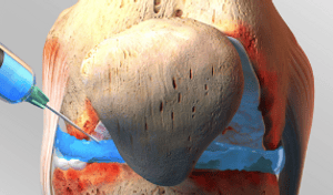 Dr.Rajinikanth's ortho clinic intra articular steroid