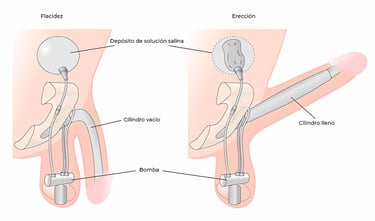 Prótesis de pene inflable