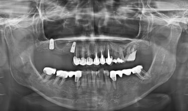 Implanturi dentare + sinus lift