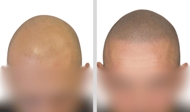 Tricopigmentation Avant Après Calvitie Perte de Densité Capillaire