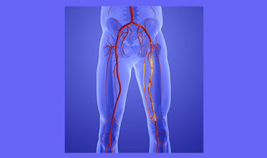vascular ultrasound artery atherosclerosis stenosis disease stent bypass graft leg pain walking claudication peripheral block