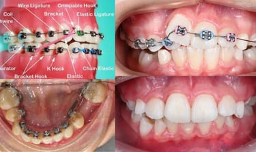 Découvrez les 10 principaux avantages prouvés des appareils orthodontiques, validés par des instance