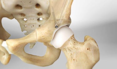 Osteotomia Periacetabular Berna Ganz