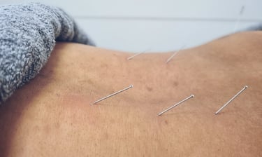 Dry needling done for Paraspinal Muscles of lower back region